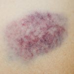 chupetones-lo-que-dicen-la-ciencia-y-las-abuelas-para-quitarlos