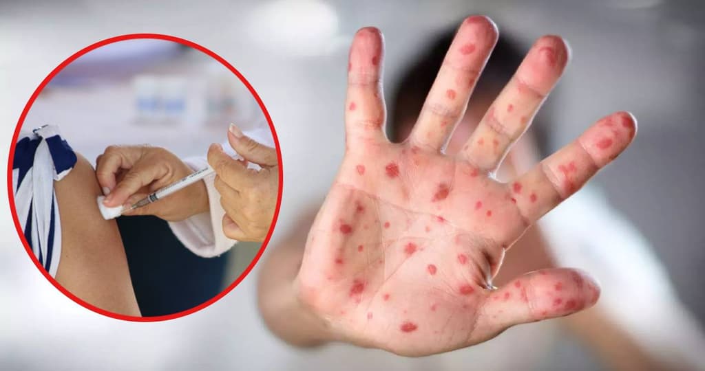 Vacuna contra el sarampión en CDMX