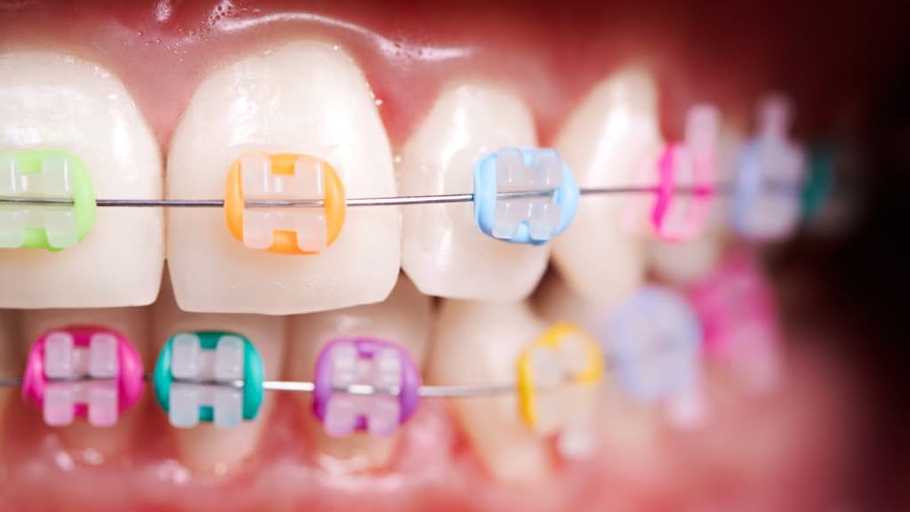 MX Brackets, tratamiento de ortodoncia