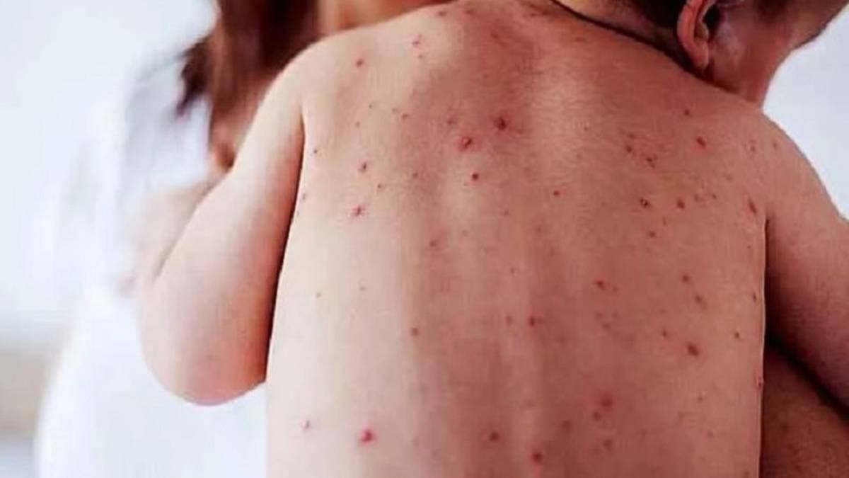 Casos de sarampión en CDMX