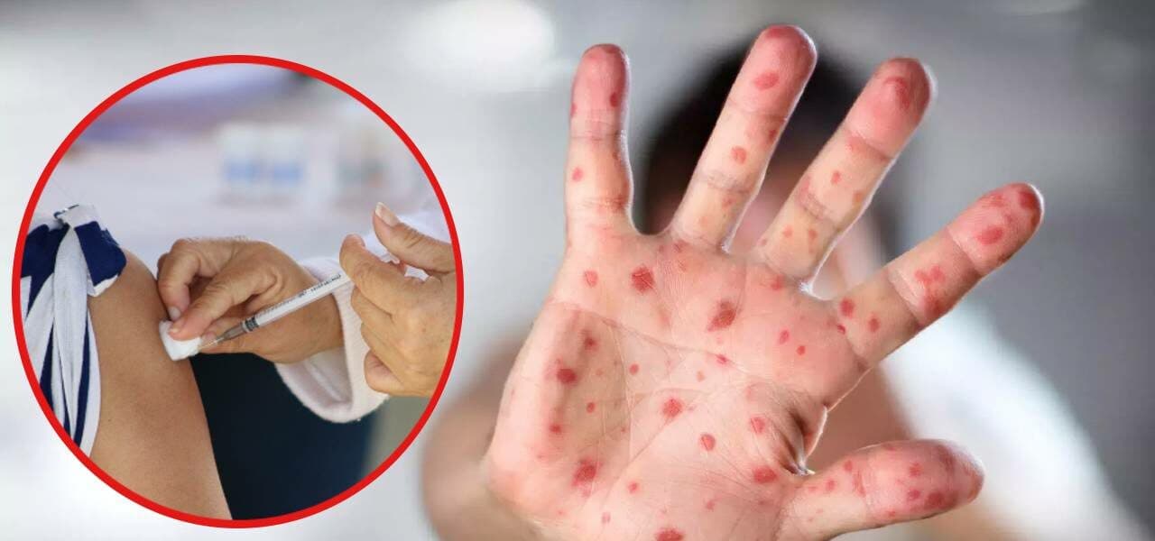 Vacuna contra el sarampión en CDMX