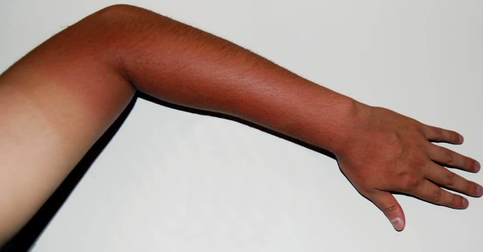 blanqueamiento de piel